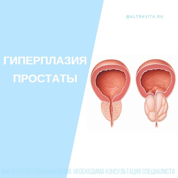 Гиперплазия предстательной железы