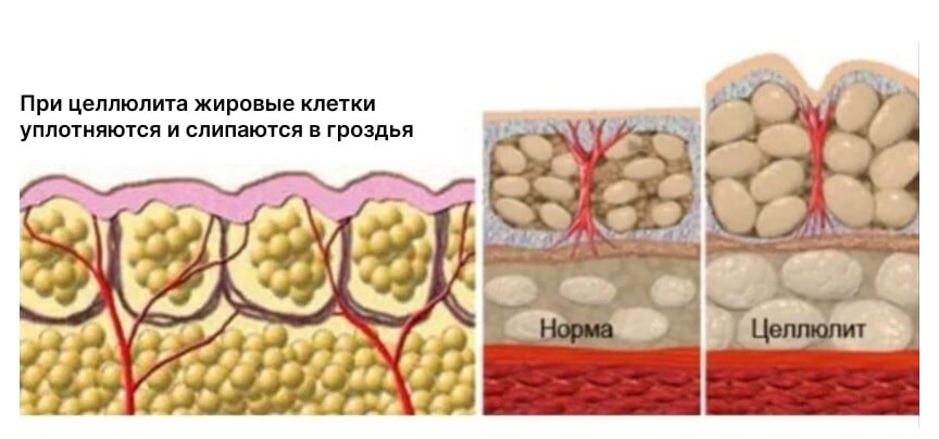 Целлюлит на клеточном уровне