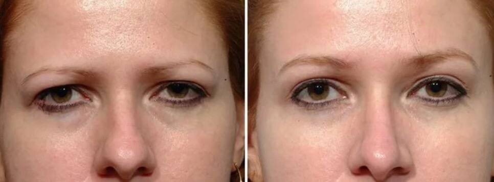 В сравнении показано, как меняется лицо при опущенном веке глаза (фото из интернета) 