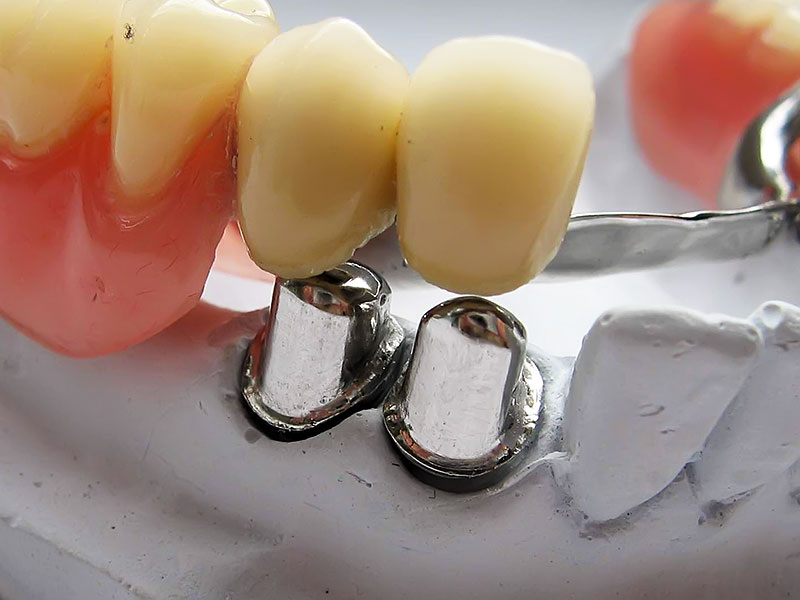 Опорные зубы покрыты металлическими колпачками, на них фиксируется коронка протеза