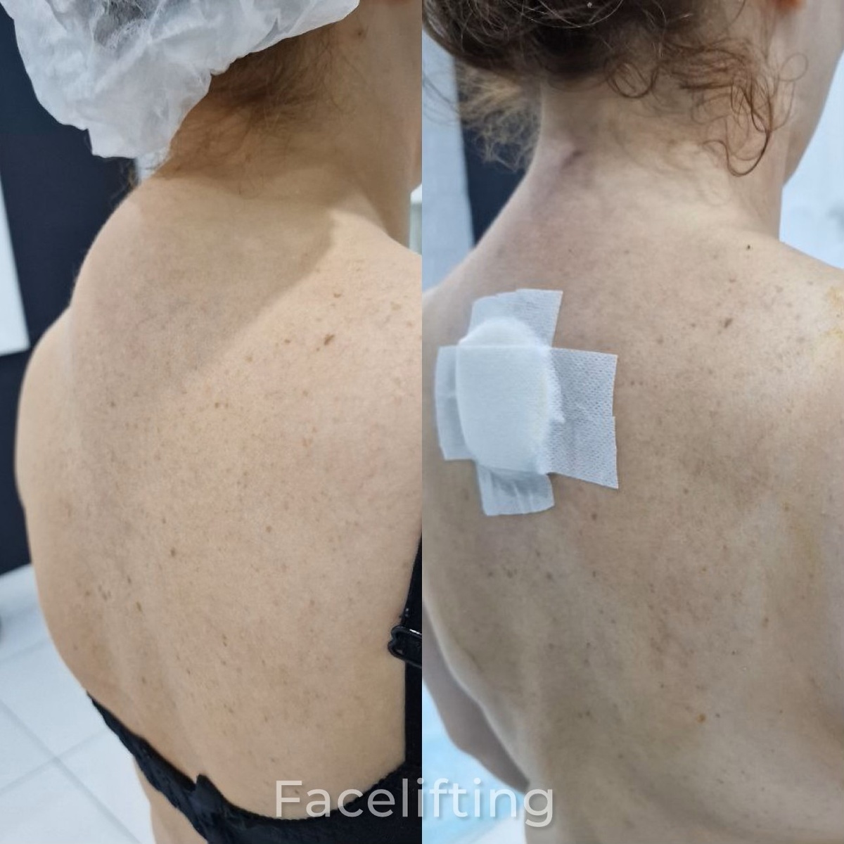 Результат после липоредукции