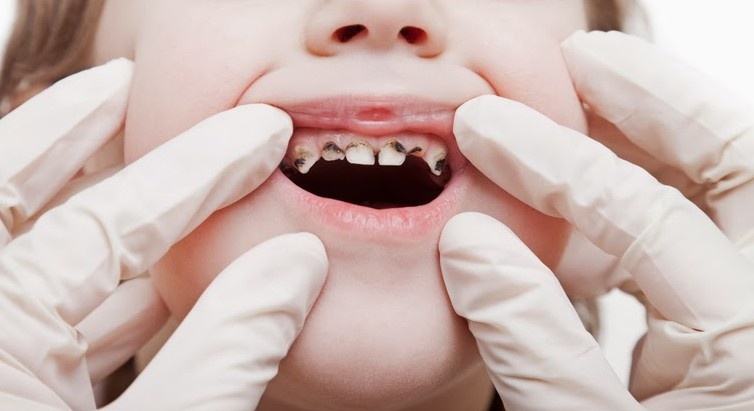 Я в шоке от похода в больницу, сколько я там увидила детей почти без зубов уже в три четыре года