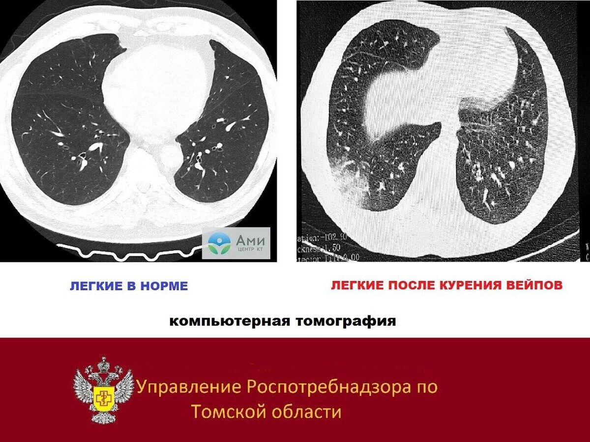    Томографический снимок "попкорновой болезни"© Роспотребнадзор Томск/Telegram