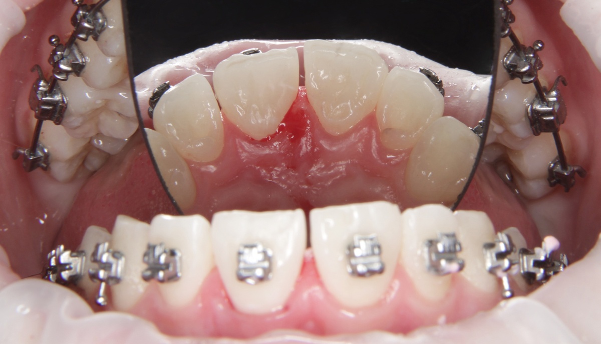 Лечение кариеса на 21 зубе.