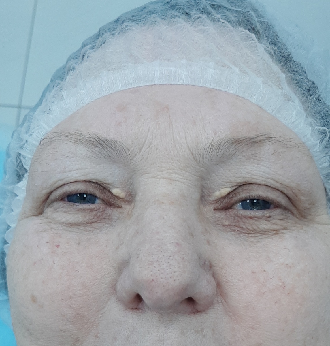 На фото состояние непосредственно перед операцией. Отчётливо видны ксантелазмы верхних век и различима небольшая ксантелазма левого века ниже внутреннего угла глаза. Также видна папиллома ресничного края нижнего века слева.