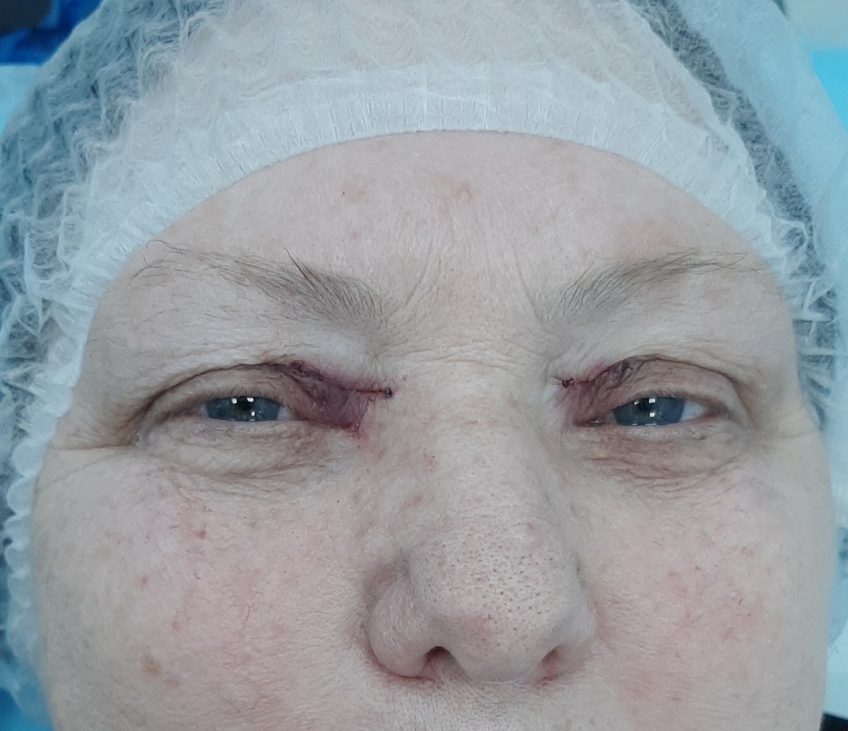 Фото сразу после удаления ксантелазм верхних век. Умеренно выраженные отёки и кровоподтеки век всегда сопутствуют этой манипуляции. Ксантелазма левого века ниже внутреннего угла глаза и папиллома ресничного края нижнего века слева пока ещё присутствуют, но они будут удалены радиоволной через несколько минут.