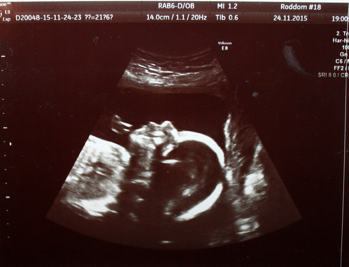 УЗИ-снимок малыша