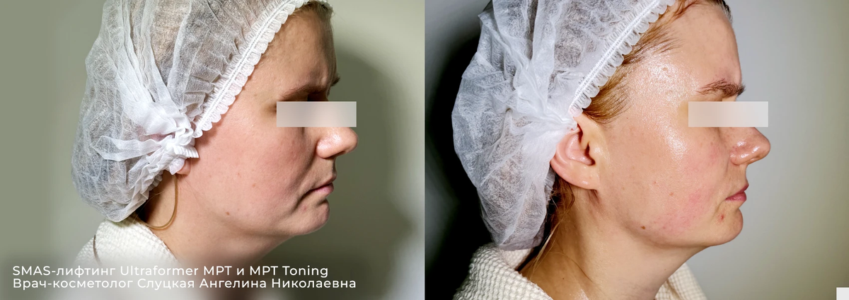 До и после смас лифтинга лица на аппарате Ultraformer MPT | клиника косметологии GEN87