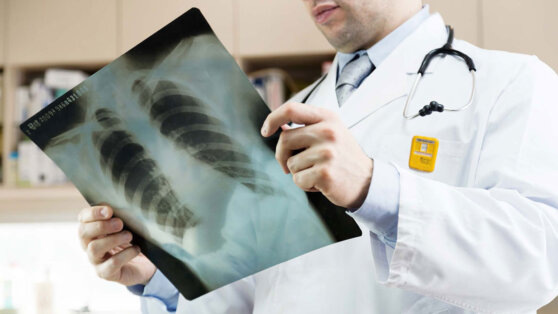    Первый случай "попкорновой болезни" зафиксировали у вейпера в России ©Moustache Girl/Shutterstock/Fotodom