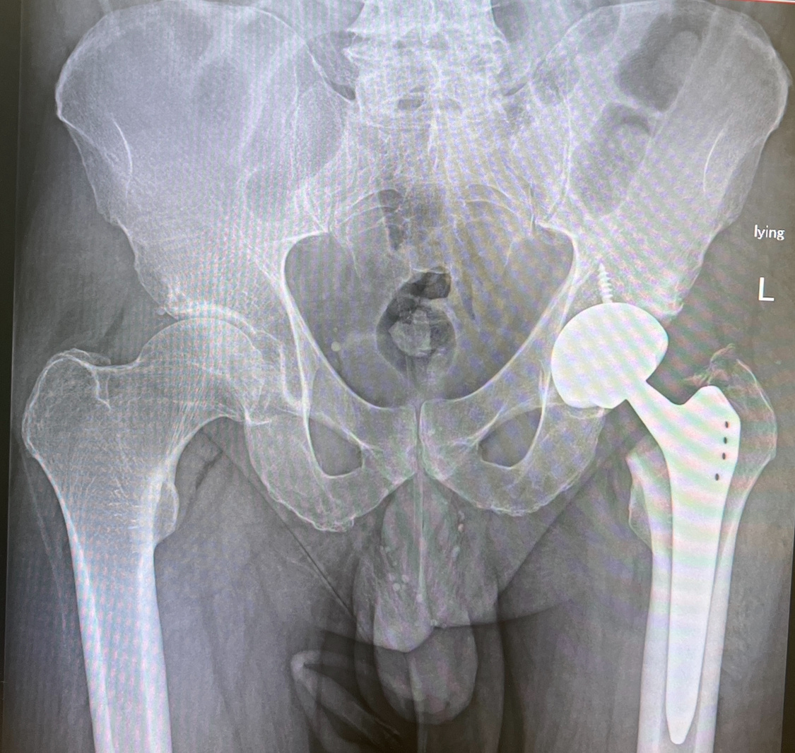 Обычное эндопротезирование