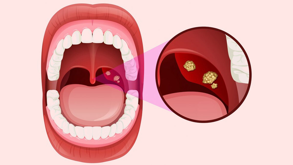 Источник картинки: https://www.onlymyhealth.com/