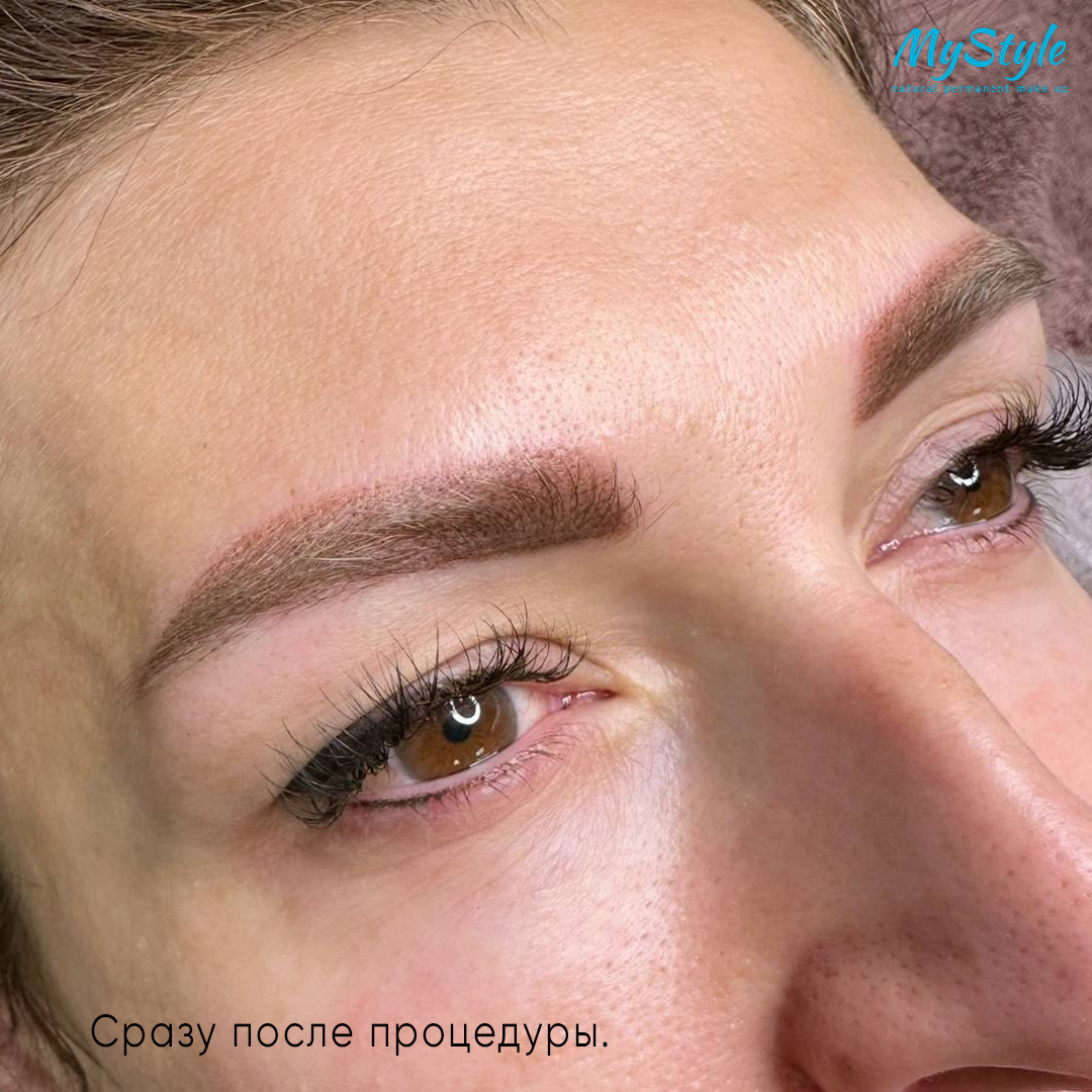 Результат сразу после процедуры и через 2 года.