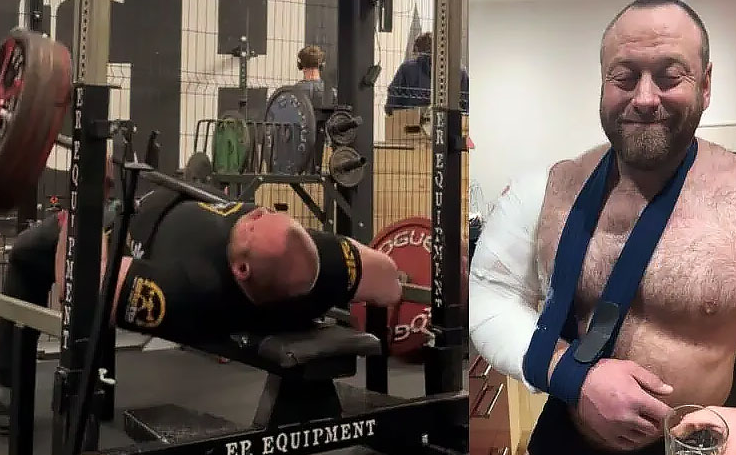 Травма. Перелом плечевой кости.