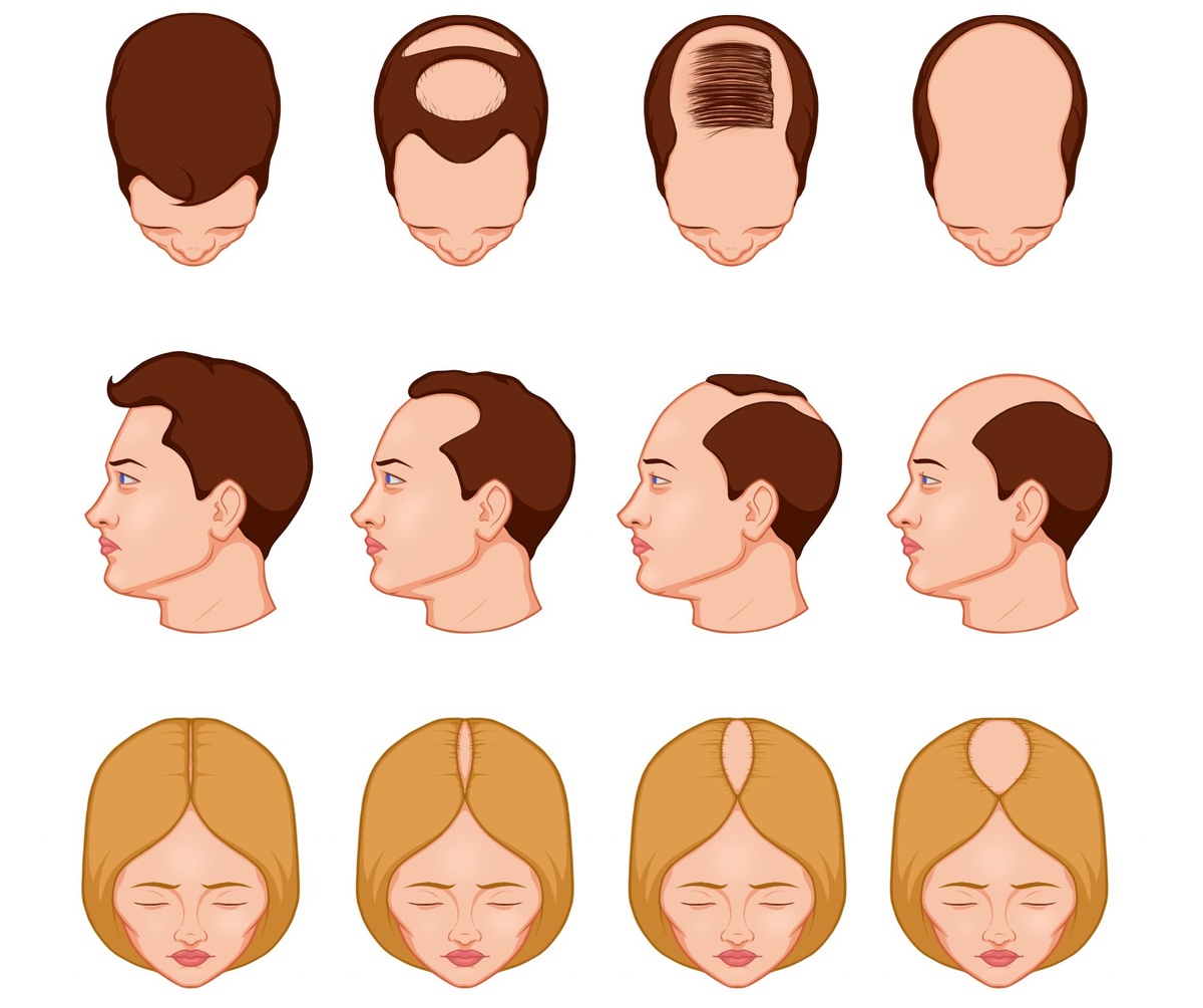 Признаки андрогенной алопеции