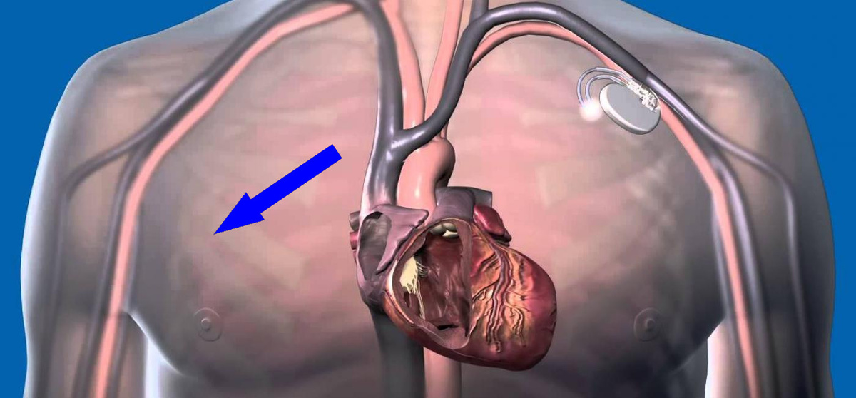    Искусственное сердце Поиск-2М: Революция в кардиологии или научная фантастика?