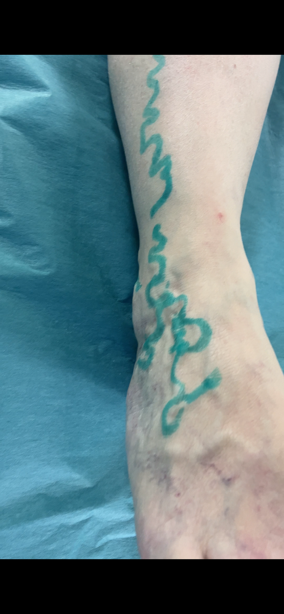 Варикоз тыльной поверхности стопы, области голеностопного сустава