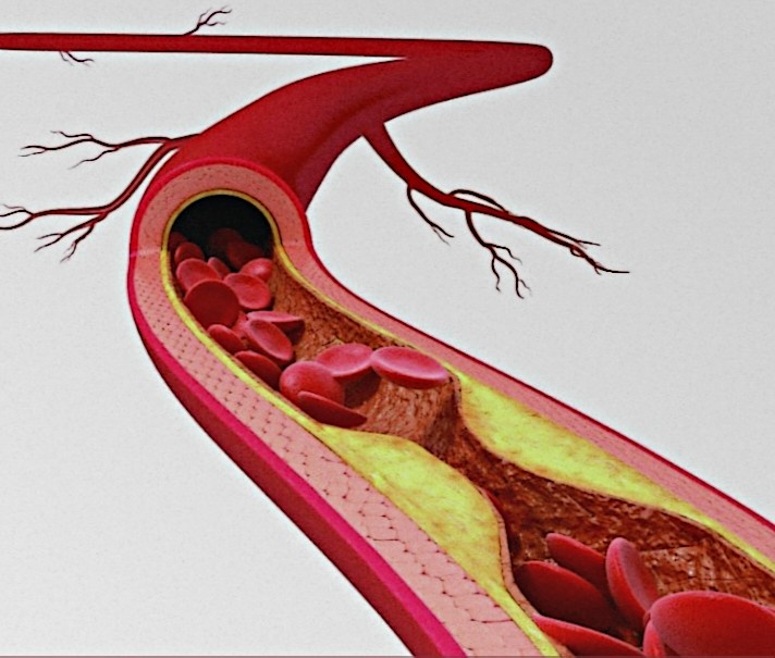 Бляшка атеросклеротическая