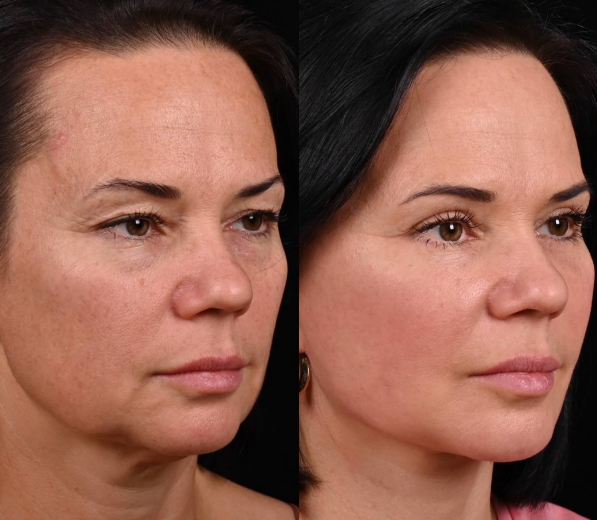 Пластика лица и шеи MACS-lift, пластика верхних век, липофилинг нижних век, трансконъюктивальная блефаропластика. Фото до и после. Фото с сайта хирурга Д.Р. Гришкяна. Имеются противопоказания, требуется консультация специалиста