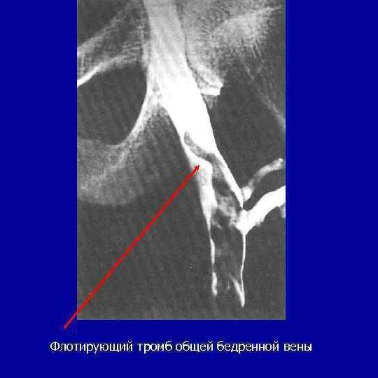 Молодому пациенту растворили огромный тромб. Случай из практики.