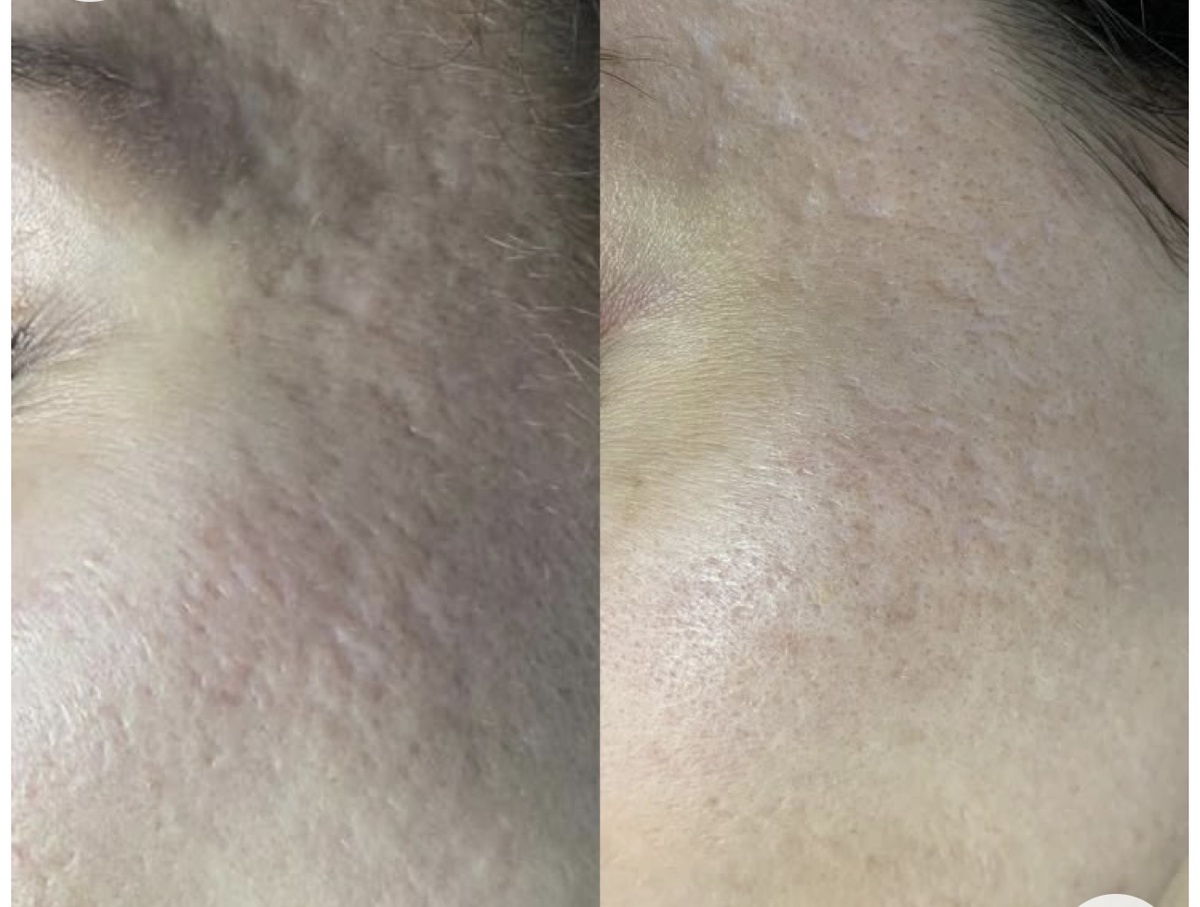 Коррекция рубцов постакне