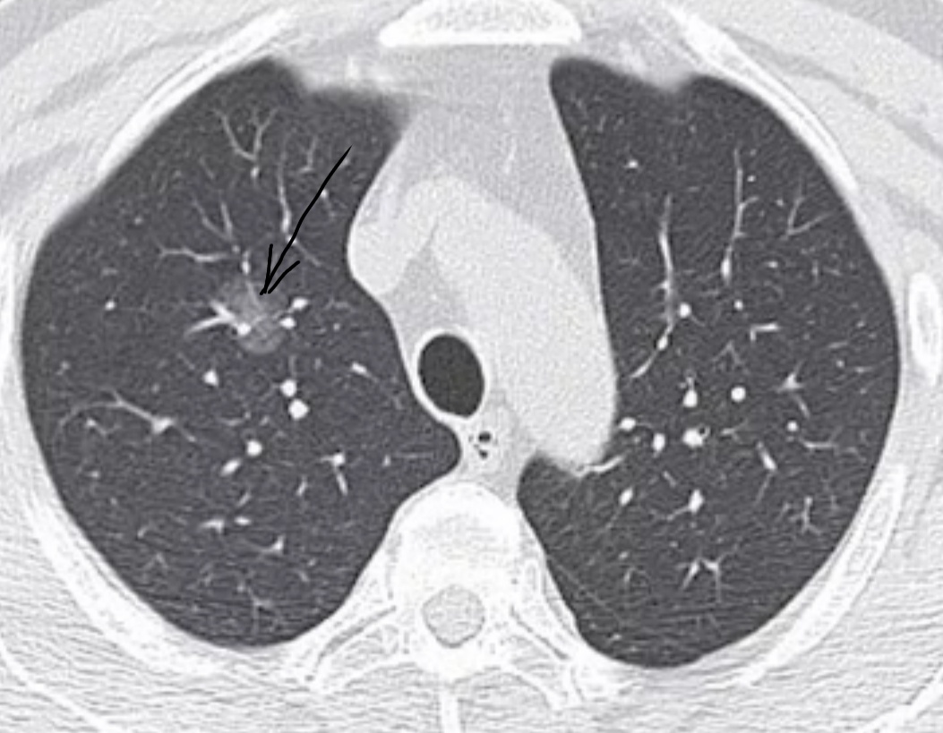 В S1 верхней доли правого лёгкого определяется очаг по типу "матового" стекла округлой формы без четких контуров, приблизительными размерами 8*8 мм. Гистологически - аденокарцинома in situ (неинвазивная форма, т.е. начальная стадия рака)