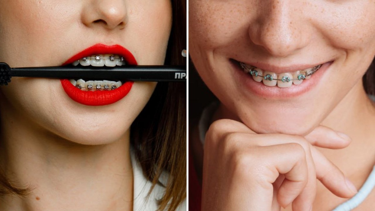 Слева на фото — самолигирующие брекеты, справа — лигатурные.