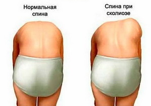 Тест Адамса