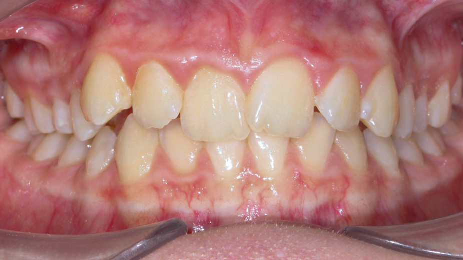 Зубы Алины ДО 