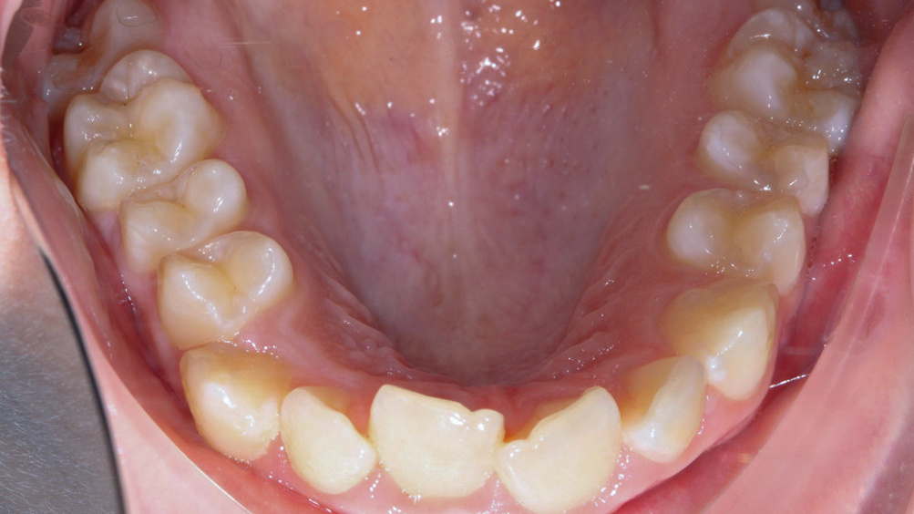 Зубы верхней челюсти до лечения