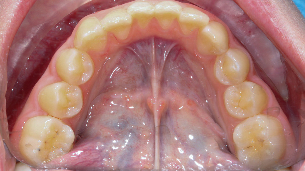 Зубы нижней челюсти до лечения
