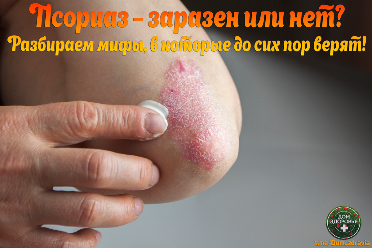 Псориаз – заразен или нет? Разбираем мифы, в которые до сих пор верят!