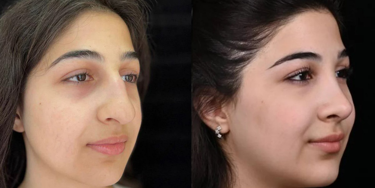 Убрали горбинку, чуть укоротили спинку и уменьшили кончик носа. Фото до и после. Фото с сайта хирурга Д.Р. Гришкяна. Имеются противопоказания, требуется консультация специалиста