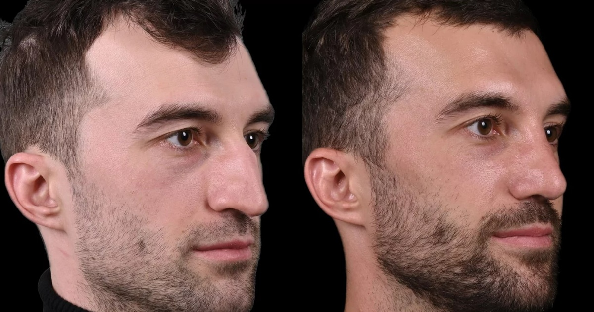 Ринопластика горбинки носа фото до и после. Фото с сайта хирурга Д.Р. Гришкяна. Имеются противопоказания, требуется консультация специалиста