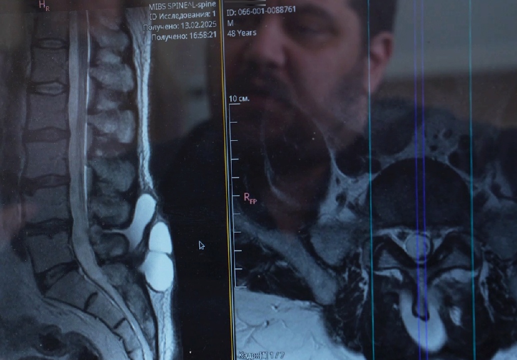 Нейрохирурги Центра Илизарова прооперировали пациента с гигантской кистой на позвоночнике