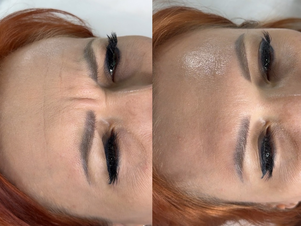 Результат до и после процедуры