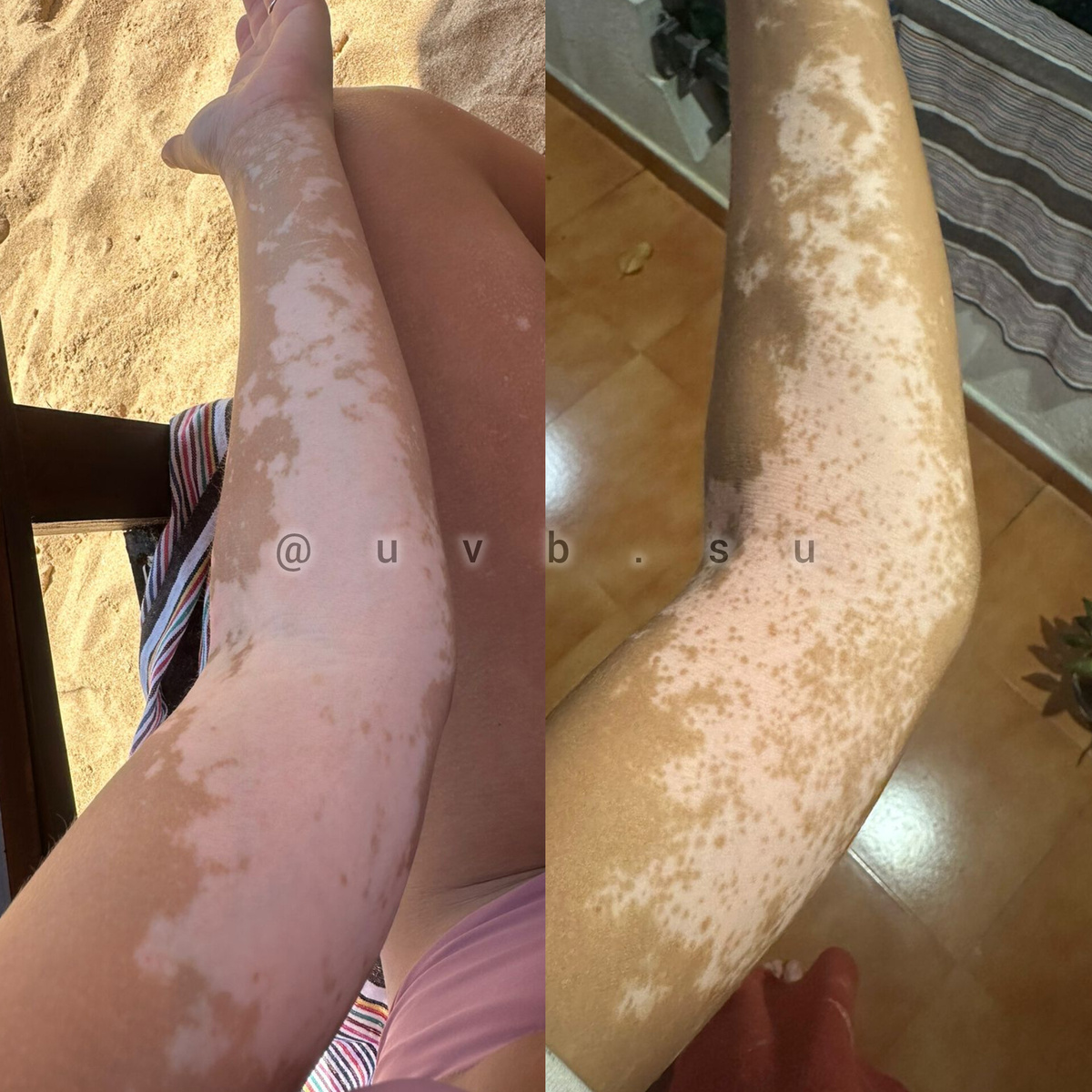 Фото витилиго ДО/ПОСЛЕ 3х месяцев соблюдения всех рекомендаций, наблюдается ~30% восстановления пигментации.