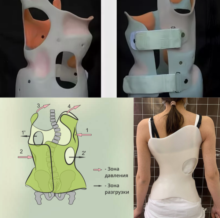 Корсет воздействует на позвоночник в трёх плоскостях, препятствуя дальнейшему распространению процесса (при соблюдении всех условий и требований для корсетотерапии)