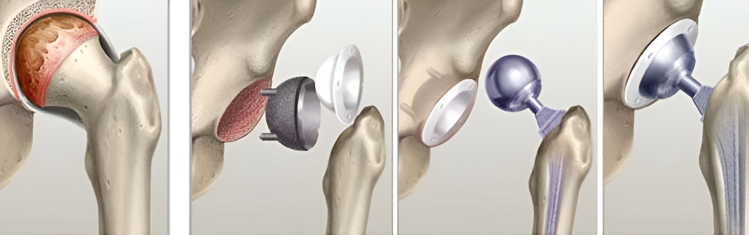 Эндопротезирование у пожилых людей: особенности операции и восстановления