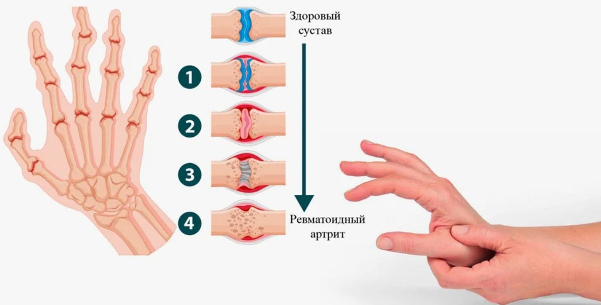 Ревматоидный артрит пальцев рук. Источник изображения https://goo.su/acV0P6