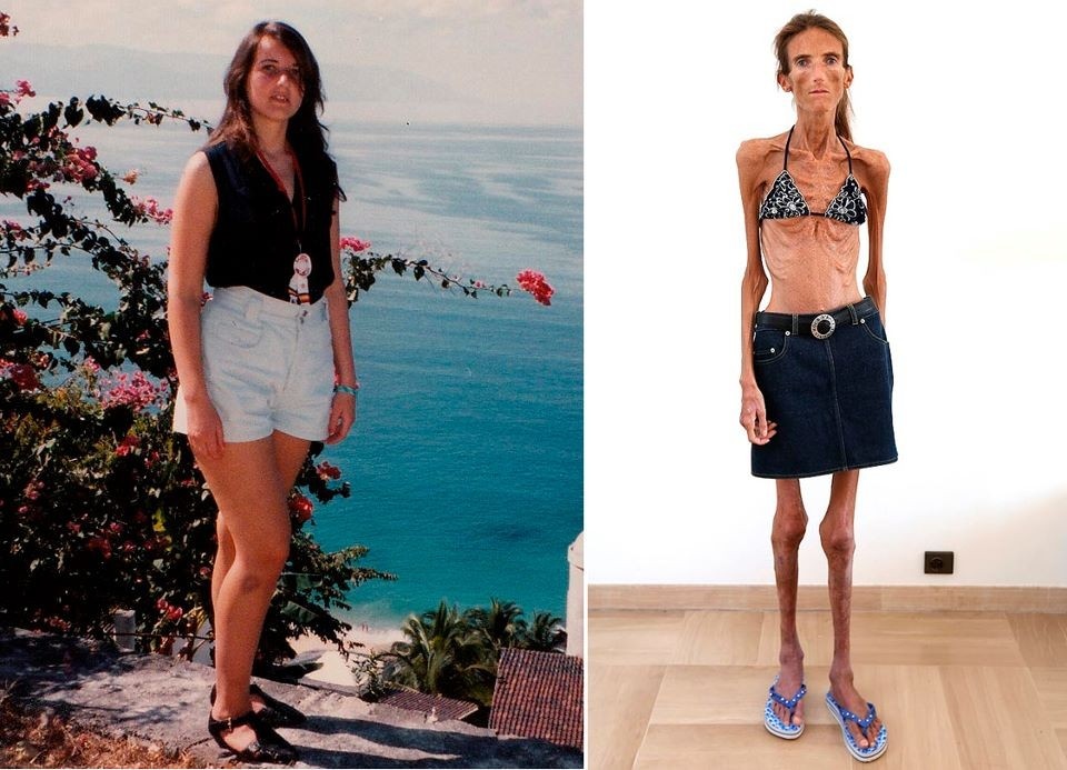 Яндекс-картинки. Передается ли анорексия по наследству? Исследования показывают, что анорексия в части случаев имеет генетическую предрасположенность, повышая риск ее развития. Это означает, что у человека могут быть определенные гены, которые делают его более уязвимым к развитию расстройства пищевого поведения, но это не гарантирует, что он обязательно заболеет. Она может возникнуть и у человека, который изначально кажется здоровым и красивым, поскольку генетика - лишь один из пазлов сложной картины расстройства.