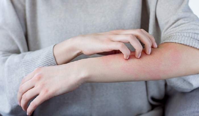    В Великобритании зафиксирована вспышка устойчивой к лечению чесотки