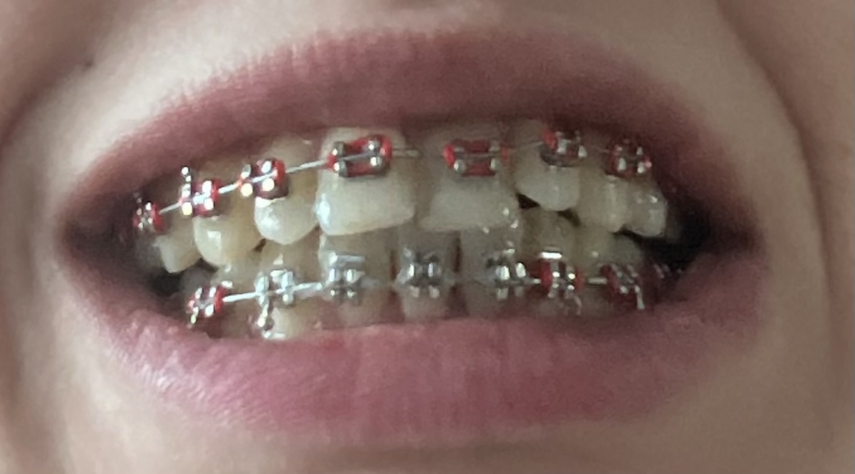 Еще есть работа, но зубы уже выглядят прилично) 