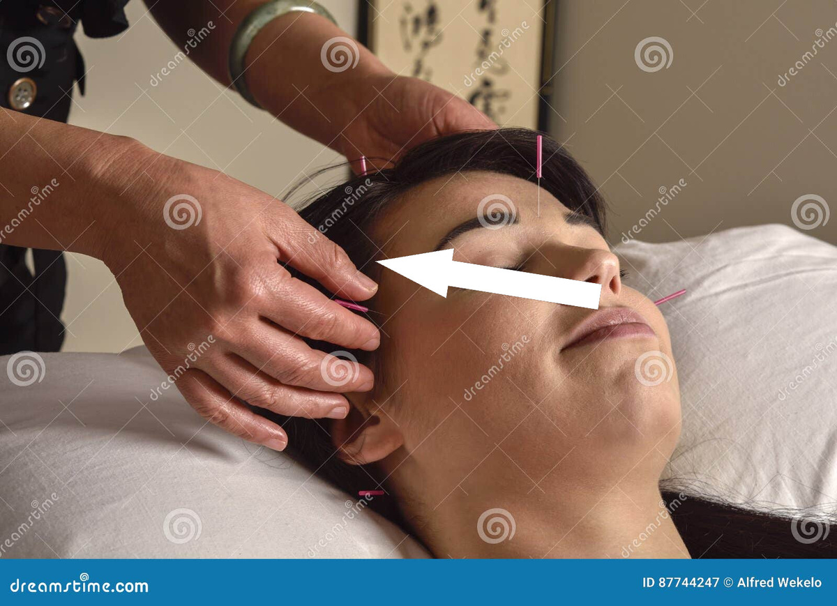    Акупунктура как путь к восстановлению: паралич и иглы, которые могут изменить жизнь