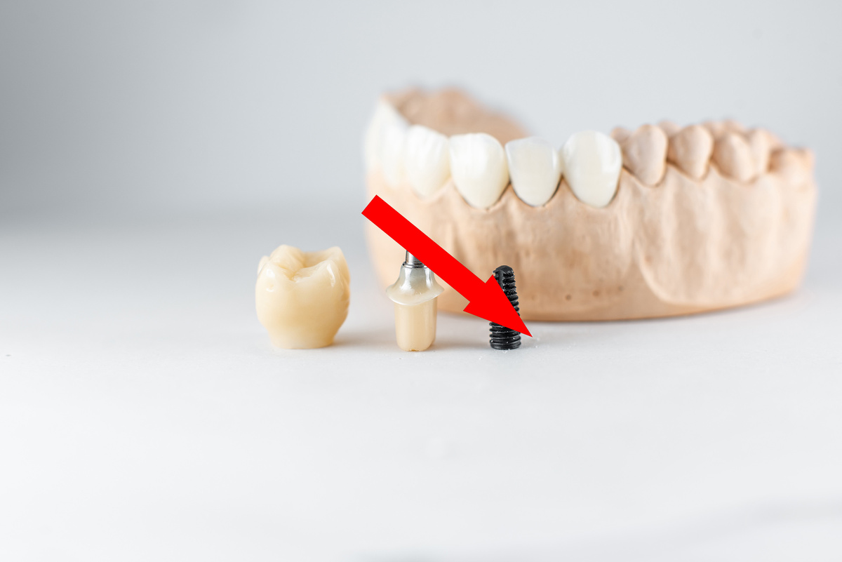    Советские танталовые импланты: возвращение в будущее стоматологии