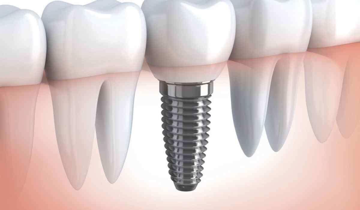    Советские танталовые импланты: возвращение в будущее стоматологии
