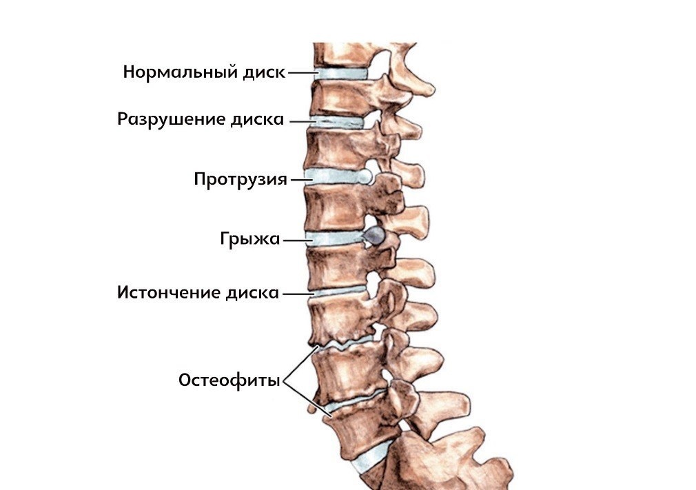 Состояния межпозвоночных дисков
