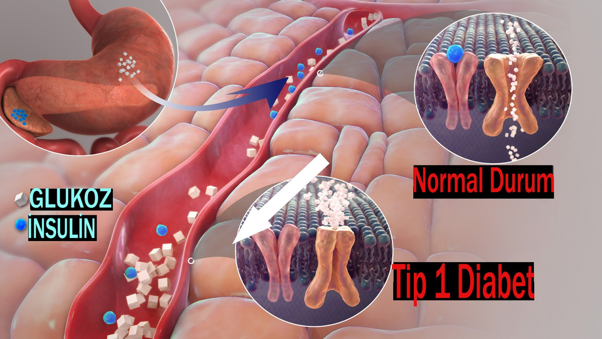    Инсулин-М: Как Искусственная Поджелудочная Железа Меняет Жизни