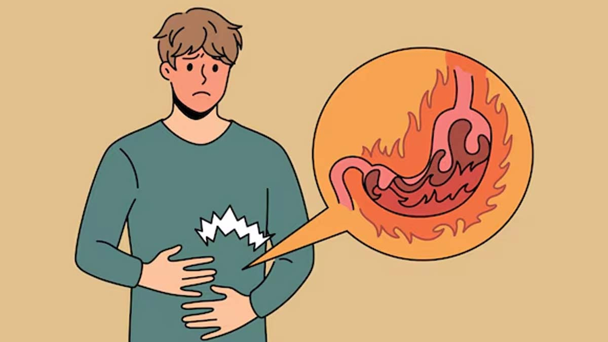 Изжога: Что с ней делать и как избавиться