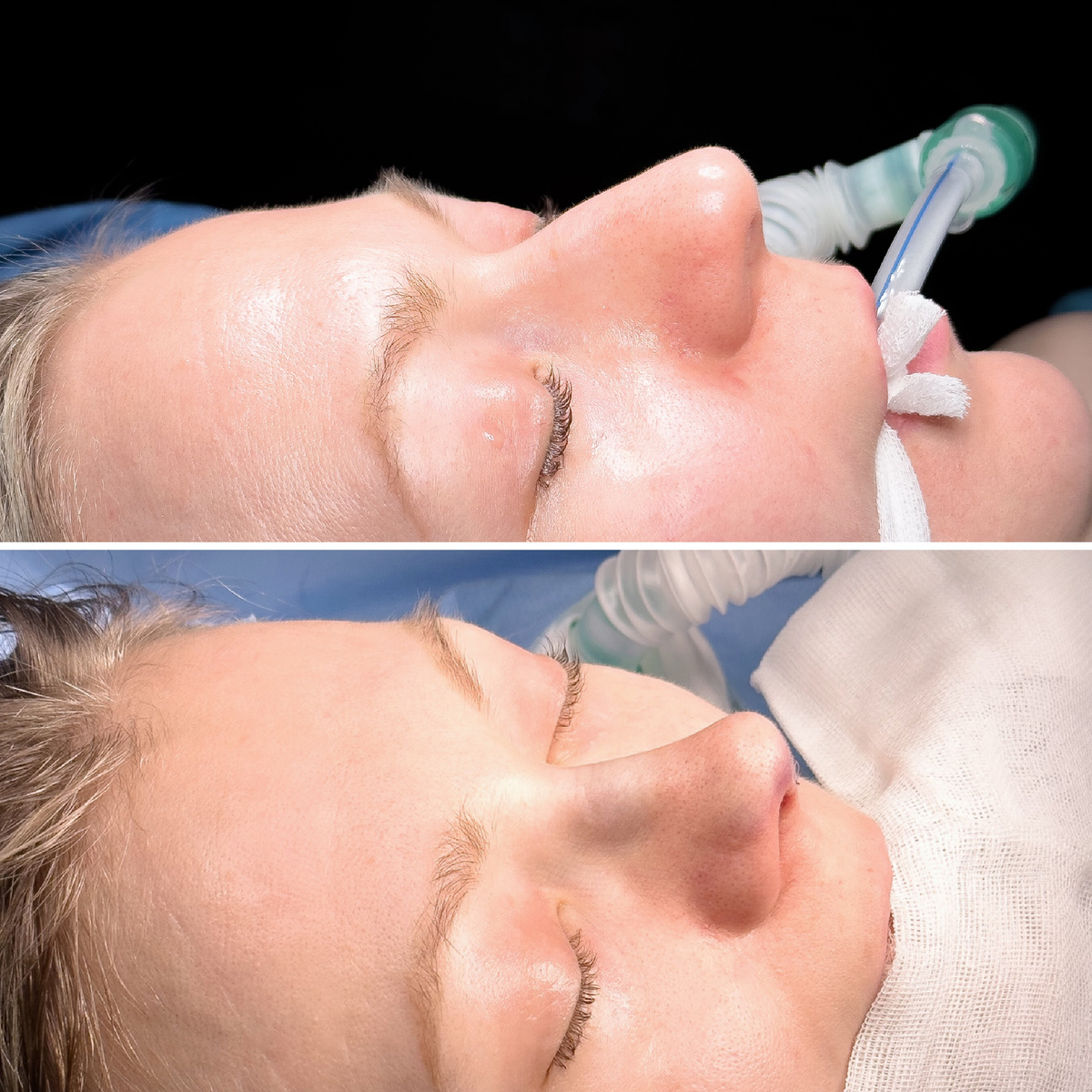 Ринопластика до и после, Пластический хиург Стайсупов В.Ю.