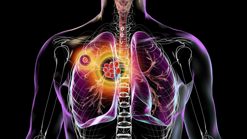     Первичный туберкулёз лёгких, иллюстрация Gettyimages.ru